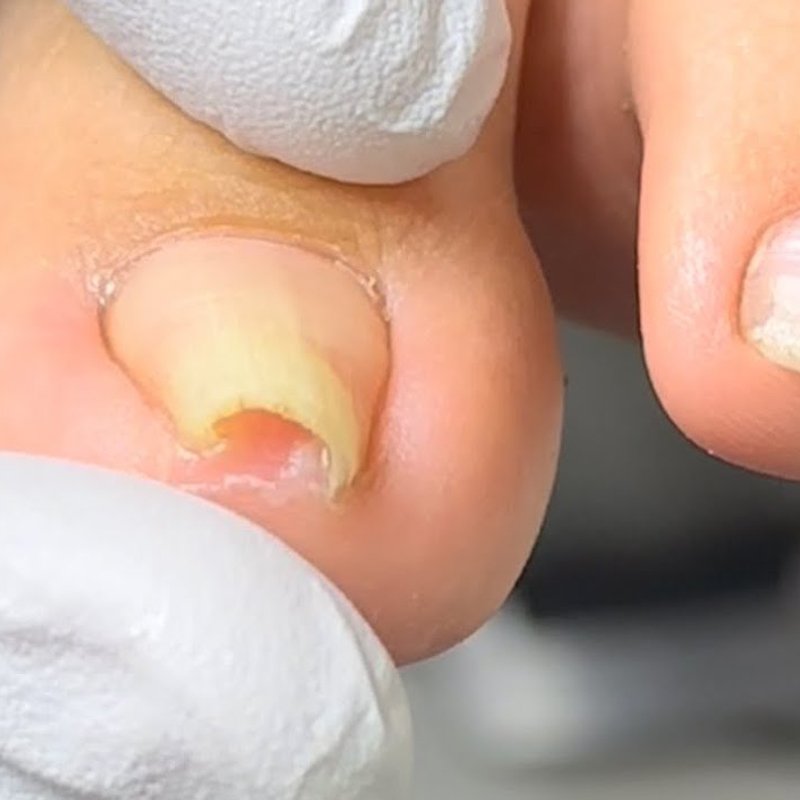 Uña involuta Camila Peñaloza Espina